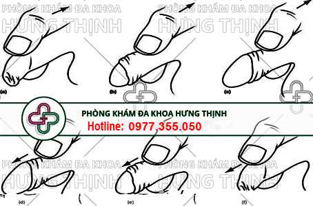 cách lột bao quy đầu tại nhà