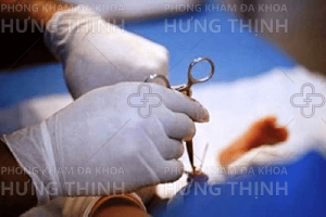 Cắt bao quy đầu là gì, tại sao phải cắt bao quy đầu?