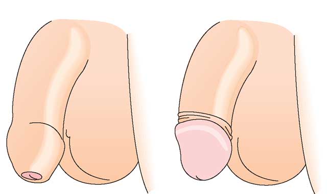 Cắt bao quy đầu là gì, tại sao phải cắt bao quy đầu?