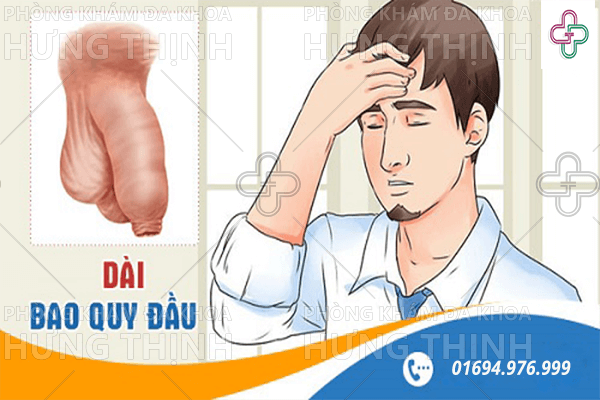 Dài bao quy đầu là gì - Nguyên nhân và Cách chữa dài bao quy đầu
