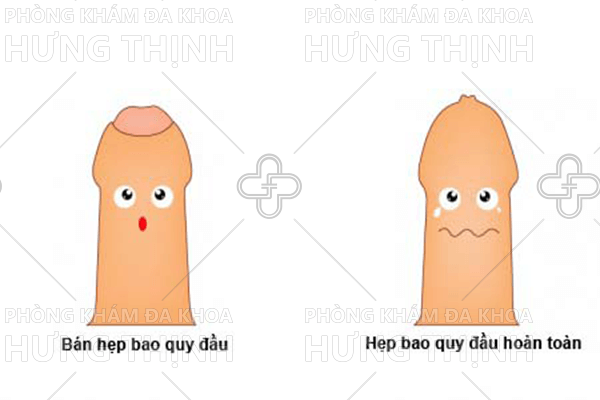 Dài và hẹp bao quy đầu có gây vô sinh không?