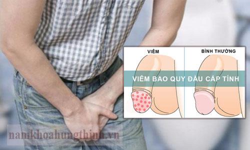 Khám bao quy đầu