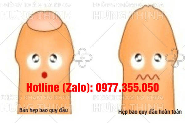 Hẹp bao quy đầu có nguy hiểm không