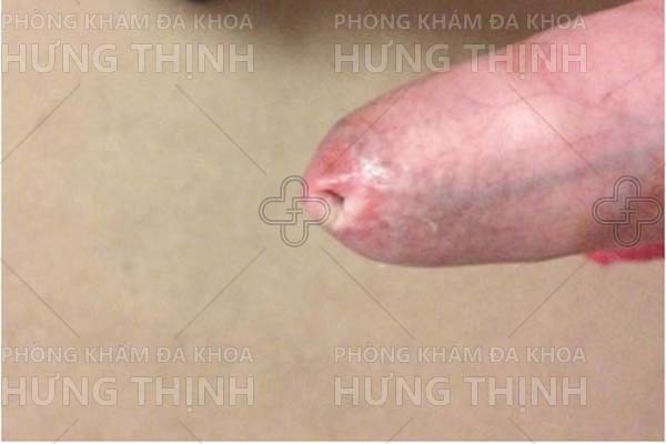 Hình ảnh hẹp bao quy đầu ở trẻ nhỏ và người lớn