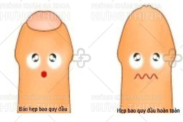 Hình ảnh hẹp bao quy đầu ở trẻ nhỏ và người lớn