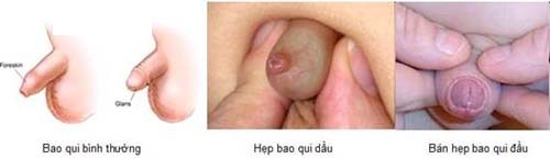 Hình ảnh hẹp bao quy đầu ở trẻ nhỏ phổ biến hiện nay