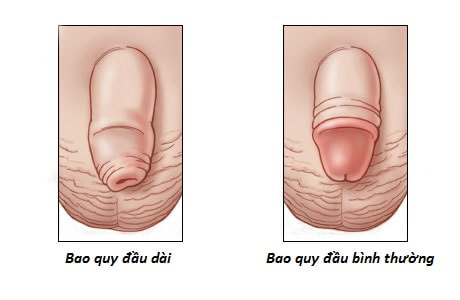 Hình ảnh hẹp, dài bao quy đầu ở trẻ nhỏ và người lớn
