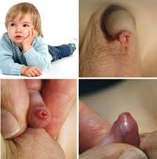 Hình ảnh hẹp bao quy đầu ở trẻ nhỏ phổ biến hiện nay