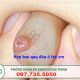 chữa hẹp bao quy đầu cho trẻ