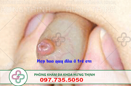 chữa hẹp bao quy đầu cho trẻ