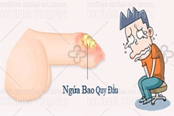 Thuốc chữa viêm bao quy đầu hiệu quả cho nam giới