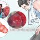 triệu chứng viêm bao quy đầu