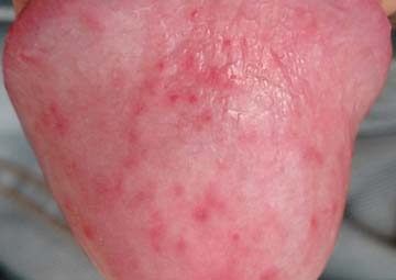 Viêm bao quy đầu là gì - Nguyên nhân, Triệu chứng, Tác hại, Cách chữa