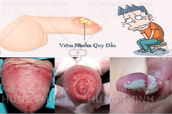 Viêm bao quy đầu là gì - Nguyên nhân, Triệu chứng, Tác hại, Cách chữa