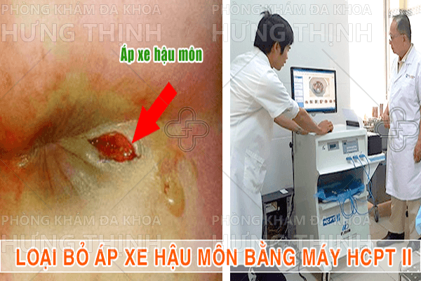 Bệnh apxe hậu môn là gì, có nguy hiểm không?