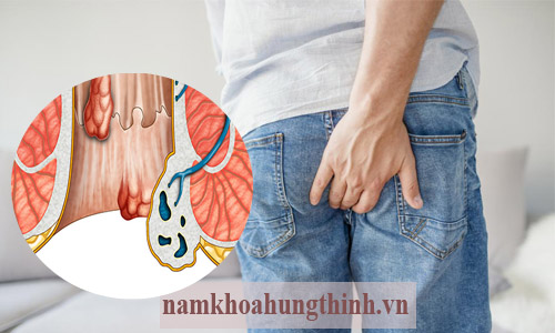 Bệnh trĩ là gì