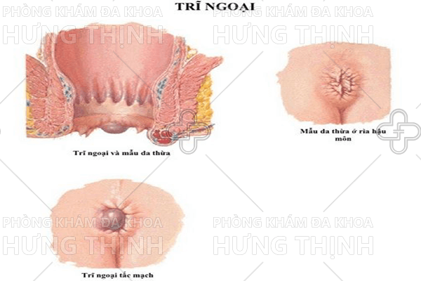 Bệnh trĩ ngoại là gì?