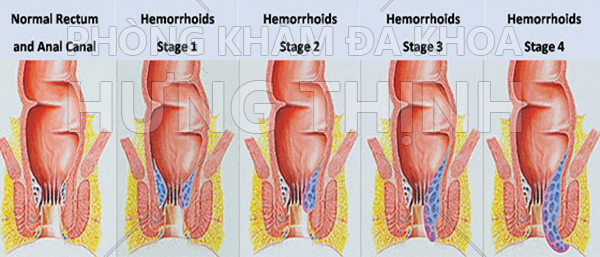 Bệnh trĩ nội là gì? Cách chữa bệnh trĩ nội hiệu quả