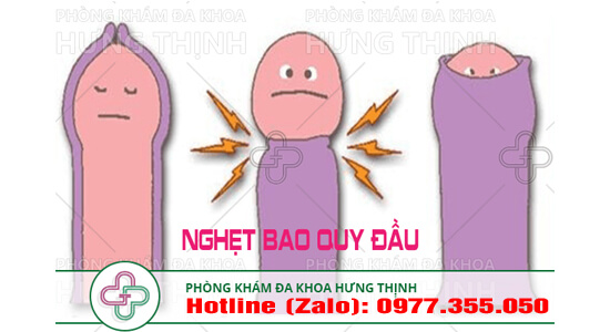 chi phí chữa nghẹt bao quy đầu