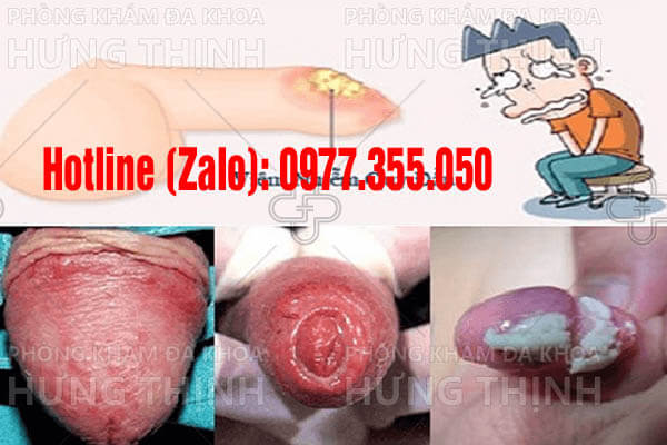 chồng bị viêm bao quy đầu có nên quan hệ không