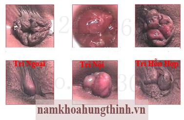 Hình ảnh bệnh trĩ nội, trĩ ngoại và trĩ hỗn hợp