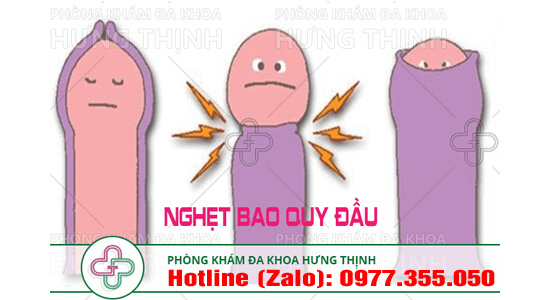 nghẹt bao quy đầu