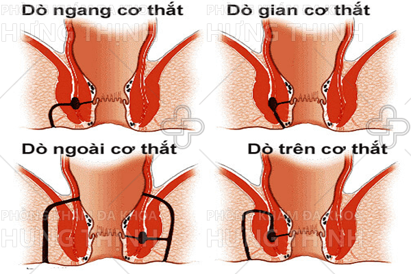 Rò hậu môn là gì, có nguy hiểm không?