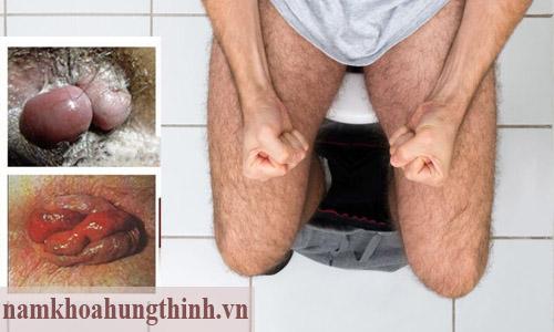 Triệu chứng của bệnh trĩ