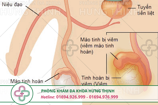 Viêm tinh hoàn là gì, nguyên nhân, triệu chứng, cách điều trị