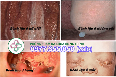 triệu chứng bệnh lậu ở nữ giới