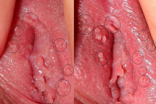 Bệnh mụn cóc sinh dục - nguyên nhân - triệu chứng và cách chữa