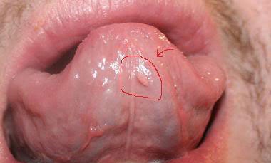 Bệnh mụn cóc sinh dục - nguyên nhân - triệu chứng và cách chữa