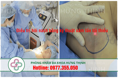 cách điều trị bệnh hôi nách
