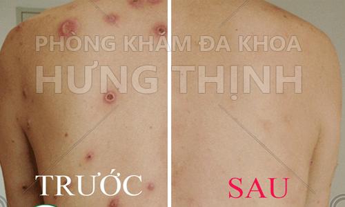 Chi phí chữa bệnh giang mai tại Hưng Thịnh