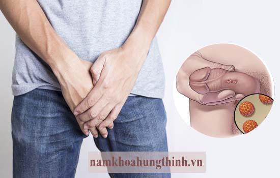 Chi phí chữa sùi mào gà bao nhiêu tiền