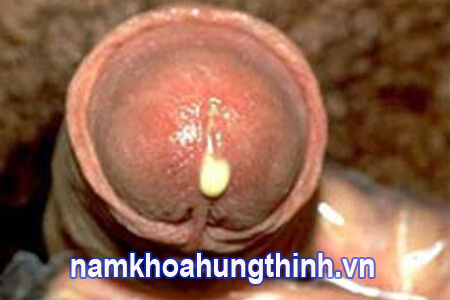 dấu hiệu bệnh lậu ở nam giới