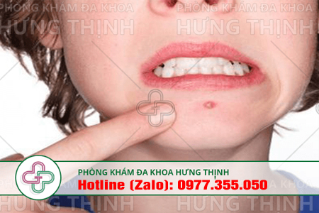 chữa mụn rộp sinh dục