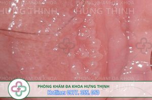 gai sinh dục nữ