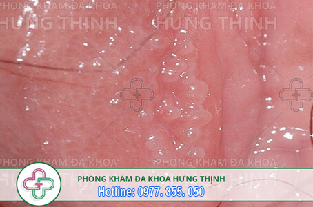 gai sinh dục nữ