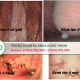 Hướng dẫn sử dụng thuốc chữa bệnh lậu hiệu quả