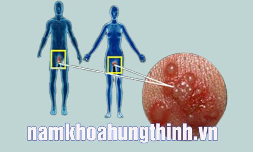 Mụn rộp sinh dục