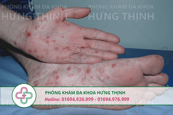 Nguyên nhân, triệu chứng, cách chữa bệnh giang mai