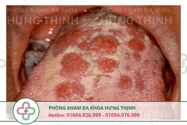 Săng giang mai là gì, có nguy hiểm không?