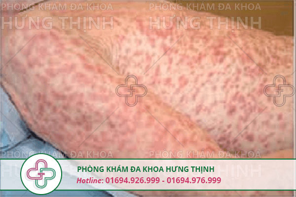 Săng giang mai là gì, có nguy hiểm không?