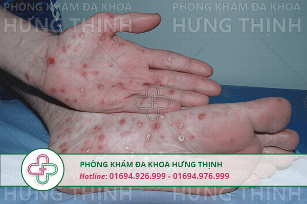 Săng giang mai là gì, có nguy hiểm không?