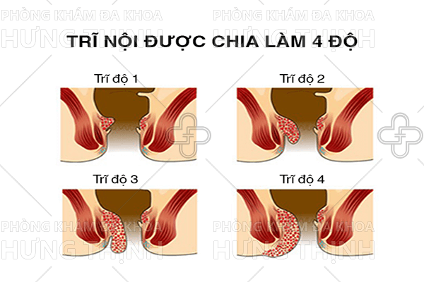 Thuốc trị bệnh trĩ nội hiệu quả
