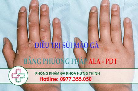 điều trị sùi mào gà