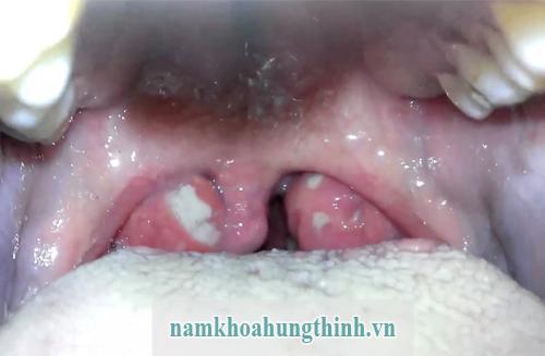 Bệnh lậu - bệnh xã hội gặp ở cả nam giới và nữ giới