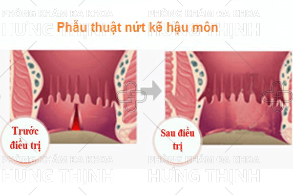 Bệnh nứt kẽ hậu môn là gì? Cách điều trị nứt kẽ hậu môn hiệu quả