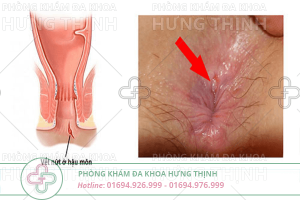 Bệnh nứt kẽ hậu môn là gì? Cách điều trị nứt kẽ hậu môn hiệu quả